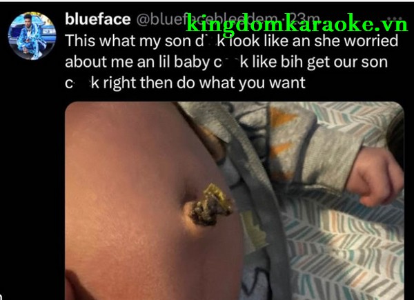 Blueface Baby Hernia Photo 